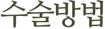 수술방법